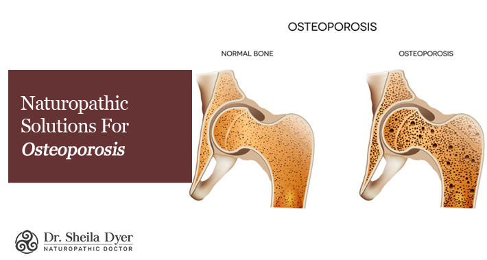 Naturopathic Solutions For Osteoporosis | Dr. Sheila Dyer, ND | Toronto Naturopath