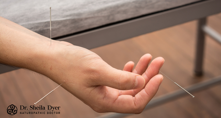 how acupuncture can help treat carpal tunnel syndrome naturopathically | Dr. Sheila Dyer, ND | Toronto Naturopath